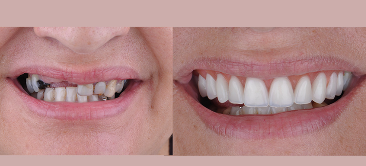 Implantes Dentários
