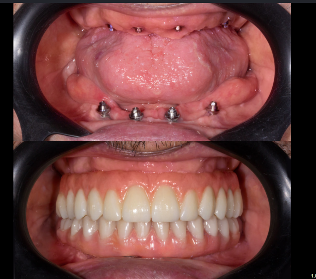 Protocolo de Dentes Fixos